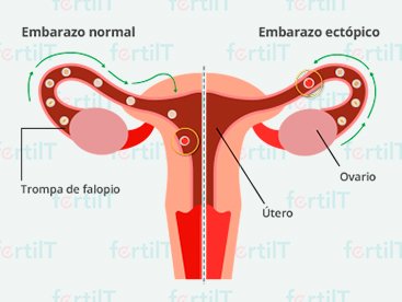 embarazo-ectopico-destacada.jpg