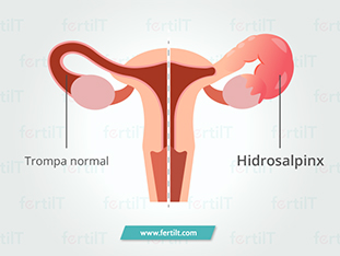 hidrosalpinx-que-es-causas-sintomas-tratamiento.jpg