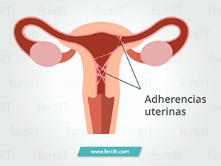 sindrome-de-asherman-que-es.jpg